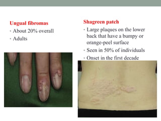 Ungual fibromas
• About 20% overall
• Adults
Shagreen patch
• Large plaques on the lower
back that have a bumpy or
orange-peel surface
• Seen in 50% of individuals
• Onset in the first decade
 