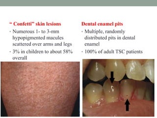 “ Confetti” skin lesions
• Numerous 1- to 3-mm
hypopigmented macules
scattered over arms and legs
• 3% in children to about 58%
overall
Dental enamel pits
• Multiple, randomly
distributed pits in dental
enamel
• 100% of adult TSC patients
 