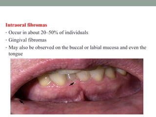 Intraoral fibromas
• Occur in about 20–50% of individuals
• Gingival fibromas
• May also be observed on the buccal or labial mucosa and even the
tongue
 