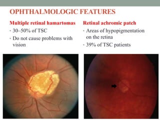 OPHTHALMOLOGIC FEATURES
Multiple retinal hamartomas
• 30–50% of TSC
• Do not cause problems with
vision
Retinal achromic patch
• Areas of hypopigmentation
on the retina
• 39% of TSC patients
 