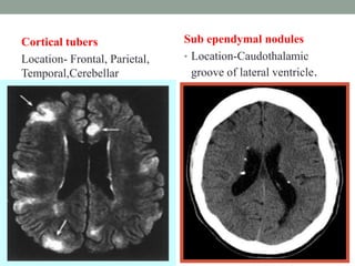 Cortical tubers
Location- Frontal, Parietal,
Temporal,Cerebellar
Sub ependymal nodules
• Location-Caudothalamic
groove of lateral ventricle.
 
