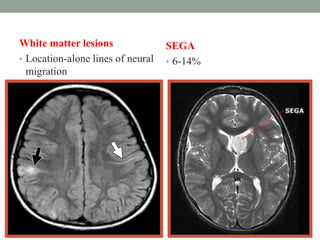 White matter lesions
• Location-alone lines of neural
migration
SEGA
• 6-14%
 