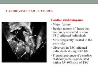 CARDIOVASCULAR FEATURES
Cardiac rhabdomyoma
• Major feature
• Benign tumors of heart that
are rarely observed in non-
TSC–affected individuals
• Most frequently located in the
ventricles
• Observed in TSC-affected
individuals during fetal life
• Prenatal presence of a cardiac
rhabdomyoma is associated
with a 75–80% risk of TSC
 