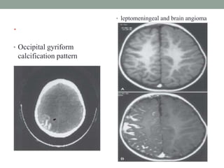 .
• Occipital gyriform
calcification pattern
• leptomeningeal and brain angioma
 