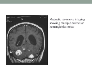 • Magnetic resonance imaging
showing multiple cerebellar
hemangioblastomas
 