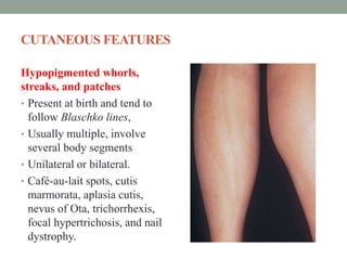 CUTANEOUS FEATURES
Hypopigmented whorls,
streaks, and patches
• Present at birth and tend to
follow Blaschko lines,
• Usually multiple, involve
several body segments
• Unilateral or bilateral.
• Café-au-lait spots, cutis
marmorata, aplasia cutis,
nevus of Ota, trichorrhexis,
focal hypertrichosis, and nail
dystrophy.
 