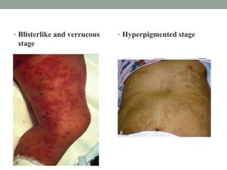 • Blisterlike and verrucous
stage
• Hyperpigmented stage
 