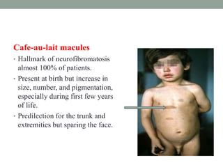 Cafe-au-lait macules
• Hallmark of neurofibromatosis
almost 100% of patients.
• Present at birth but increase in
size, number, and pigmentation,
especially during first few years
of life.
• Predilection for the trunk and
extremities but sparing the face.
 