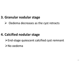 3. Granular nodular stage
 Oedema decreases as the cyst retracts
4. Calcified nodular stage
End-stage quiescent calcified cyst remnant
No oedema
15
 
