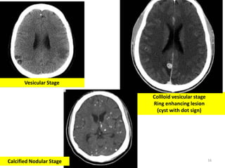 16
Collloid vesicular stage
Ring enhancing lesion
(cyst with dot sign)
Calcified Nodular Stage
Vesicular Stage
 