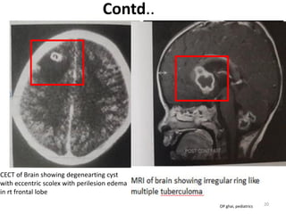 Contd..
CECT of Brain showing degenearting cyst
with eccentric scolex with perilesion edema
in rt frontal lobe
Caseating granulomatous inflammation
associated with a fibrous type capsule,
20OP ghai, pediatrics
 