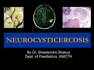 NEUROCYSTICERCOSIS By Dr. Sheelendra Shakya Dept. of Paediatrics, KMCTH 
