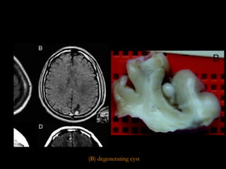 (B) degenerating cyst 