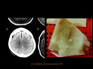 (C) calcified cyst (non-contrast CT)   
