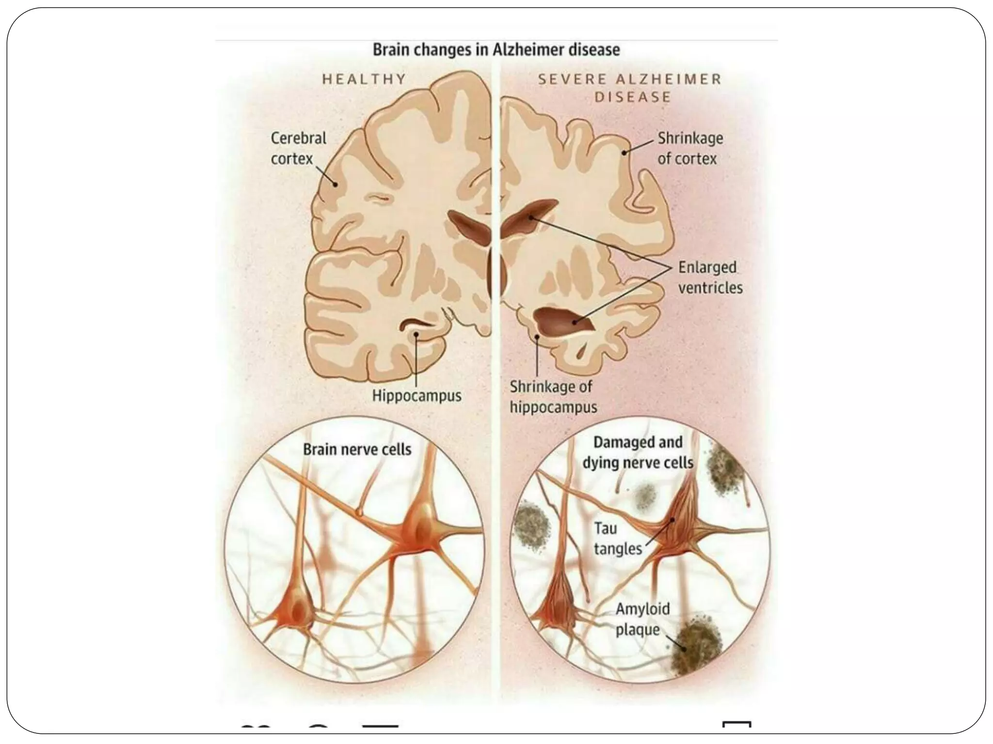 Neurodegenerative diseases ppt ppt
