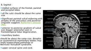 B. Sagittal :
medial surfaces of the frontal, parietal
and occipital lobes
all the sulci should be about the same
size
Significant parietal sulcal widening with
atrophy of the precuneus and posterior
cingulate suggests Alzheimer's disease
(AD).
anterior to posterior gradient of sulcal
size (bigger anteriorly) seen in
frontotemporal lobar degeneration.
mamillary bodies
should be about the same size. Atrophic
or asymmetrical mammillary bodies may
imply hippocampal pathology or
Wernicke-Korsakoff syndrome.
upper cervical spine and cord.
 