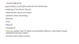 Axial FLAIR & T2
•gyral atrophy, particularly useful for the frontal lobes
•widening of the sylvian fissures
•hippocampal volume and signal
•posterior fossa morphology
•Midbrain
•Pons
•Medulla
•Cerebellum
•Wernicke pattern high T2 signal (ventromedial thalamus, mammillary bodies,
periaqueductal grey matter)
•Cortical white matter changes.
 
