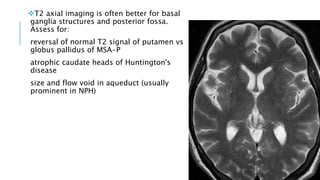 T2 axial imaging is often better for basal
ganglia structures and posterior fossa.
Assess for:
reversal of normal T2 signal of putamen vs
globus pallidus of MSA-P
atrophic caudate heads of Huntington's
disease
size and flow void in aqueduct (usually
prominent in NPH)
 