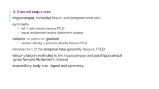 3. Coronal sequences
•hippocampal, choroidal fissure and temporal horn size
•symmetry
• left > right atrophy favours FTLD
• equal involvement favours Alzheimer's disease
•anterior to posterior gradient
• anterior atrophy > posterior atrophy favours FTLD
•involvement of the temporal lobe generally favours FTLD
•atrophy largely restricted to the hippocampus and parahippocampal
gyrus favours Alzheimer's disease
•mammillary body size, signal and symmetry
 
