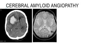 CEREBRAL AMYLOID ANGIOPATHY
 