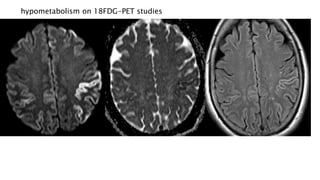 hypometabolism on 18FDG-PET studies
 