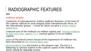RADIOGRAPHIC FEATURES
MRI
midbrain atrophy
reduction of anteroposterior midline midbrain diameter, at the level of
the superior colliculi on axial imaging (from interpeduncular fossa, to
the intercolicular groove: <12mm 8): which can give a mickey mouse
appearance
reduced area of the midbrain on midline sagittal and reduced midbrain
to pons area ratio: approx 0.12 (normal approx 0.24) on midline
sagittal
Loss of the lateral convex margin of the tegmentum of midbrain has
been described as the morning glory sign
hummingbird sign also known as the penguin sign. The key is a
flattening or concave outline to the superior aspect of the midbrain
which should be upwardly convex
 