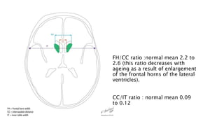 FH/CC ratio :normal mean 2.2 to
2.6 (this ratio decreases with
ageing as a result of enlargement
of the frontal horns of the lateral
ventricles).
CC/IT ratio : normal mean 0.09
to 0.12
 