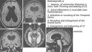 Radiologically w
1. degeree of ventricular dilatation is
more with Thinning and bowing of CC
2. Sulcal effacement is invariable seen
Hydrocephalus
3. dilatation or rounding of the Temporal
Horns.
4. Rounding and enlargement of the
frontal horns
5. Enlargement and ballooning of 3rd
ventricle
6. Enlargement of fourth ventricle.
 