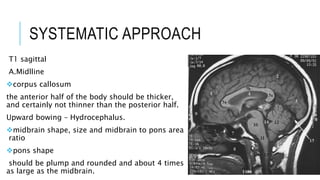 SYSTEMATIC APPROACH
T1 sagittal
A.Midlline
corpus callosum
​the anterior half of the body should be thicker,
and certainly not thinner than the posterior half.
Upward bowing – Hydrocephalus.
midbrain shape, size and midbrain to pons area
ratio
pons shape
should be plump and rounded and about 4 times
as large as the midbrain.
 