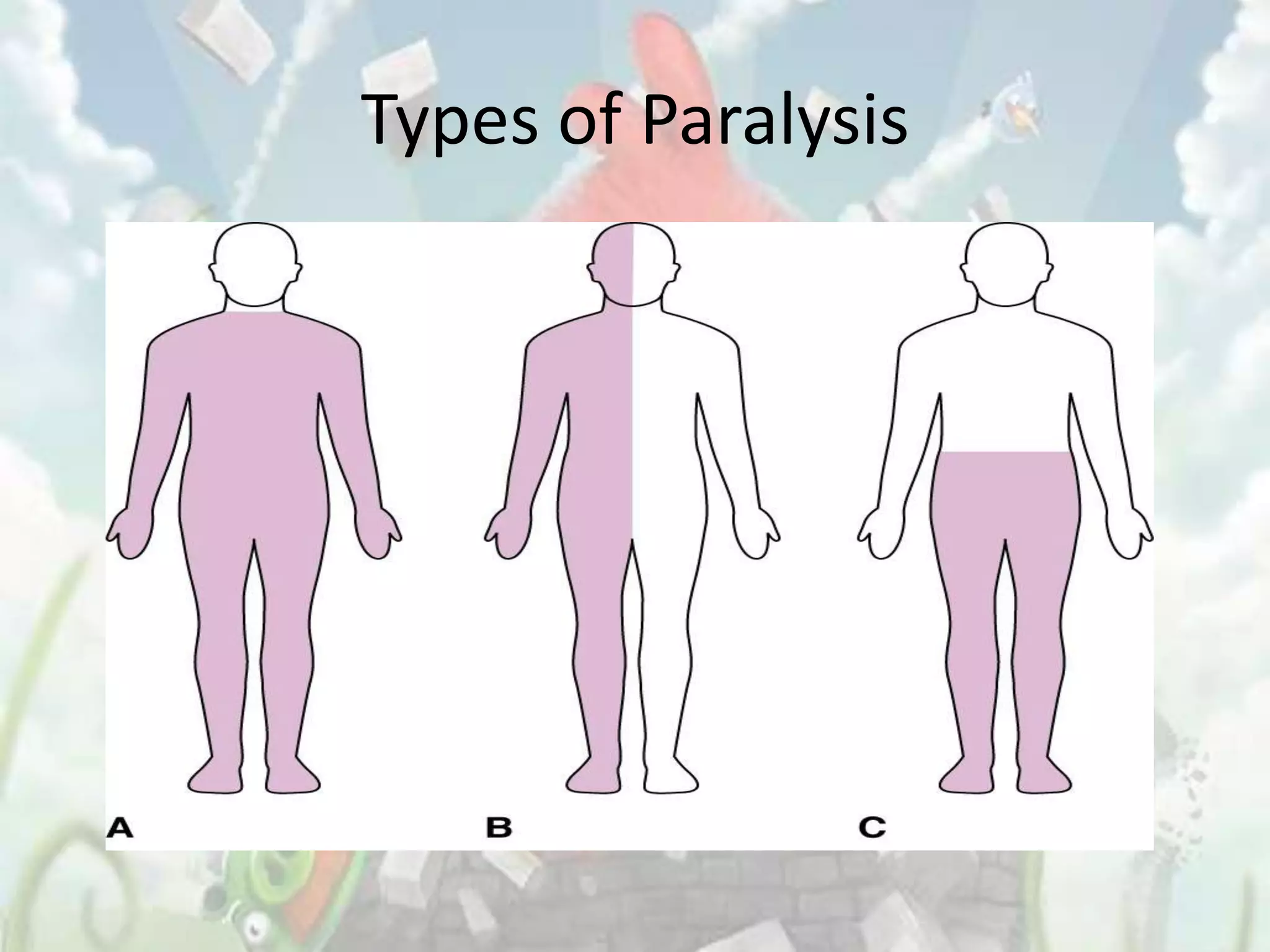 Types of Paralysis
 