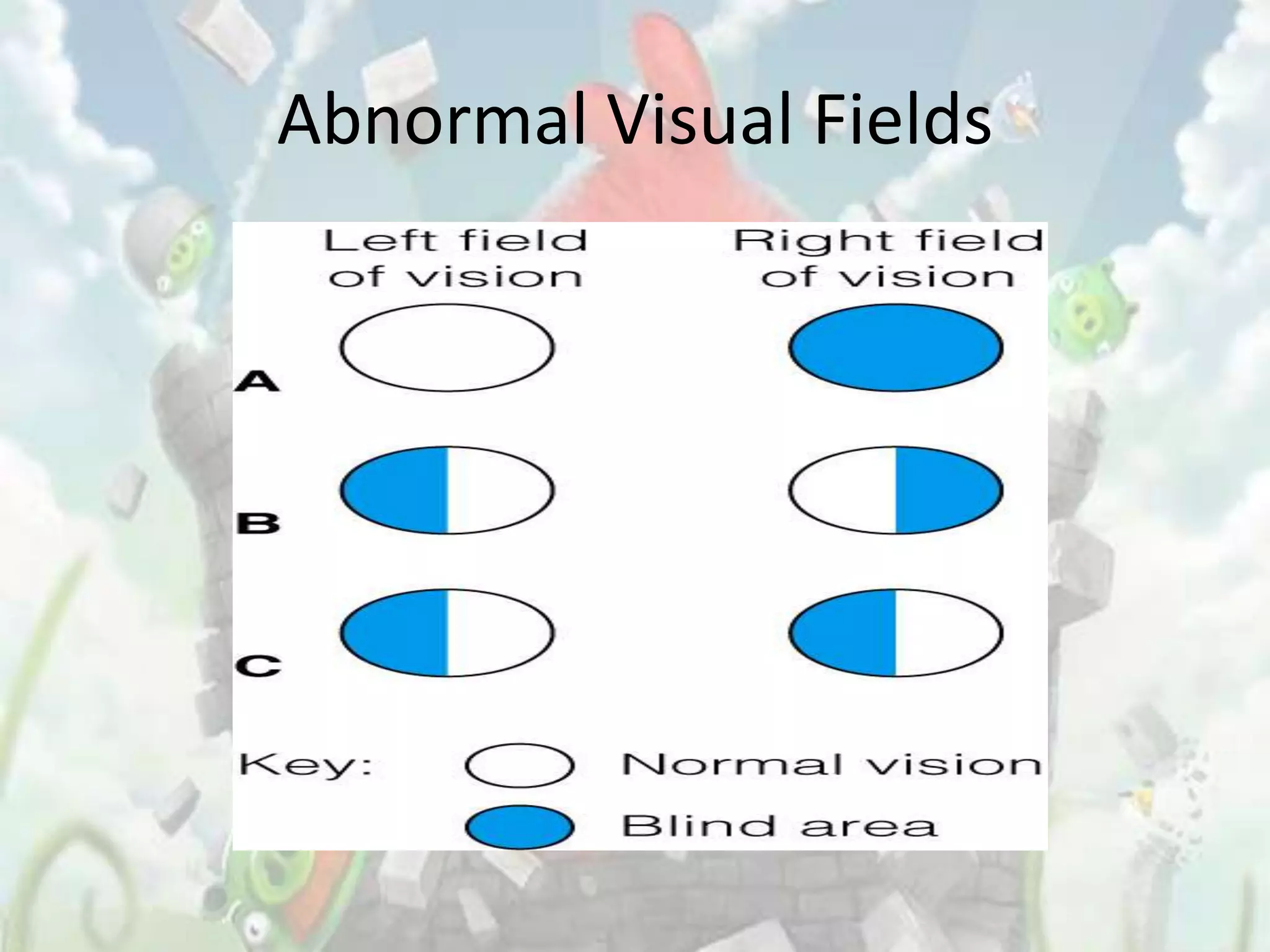 Abnormal Visual Fields
 