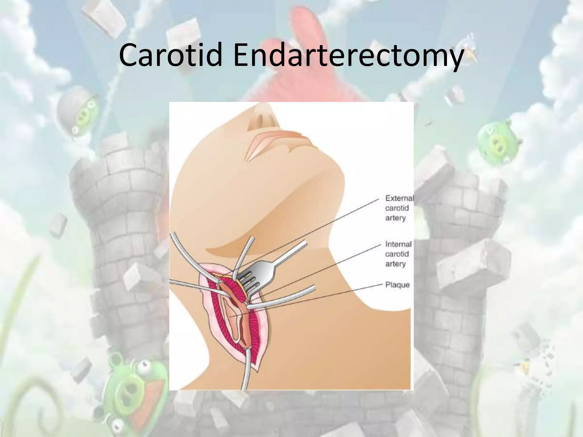 Carotid Endarterectomy
 