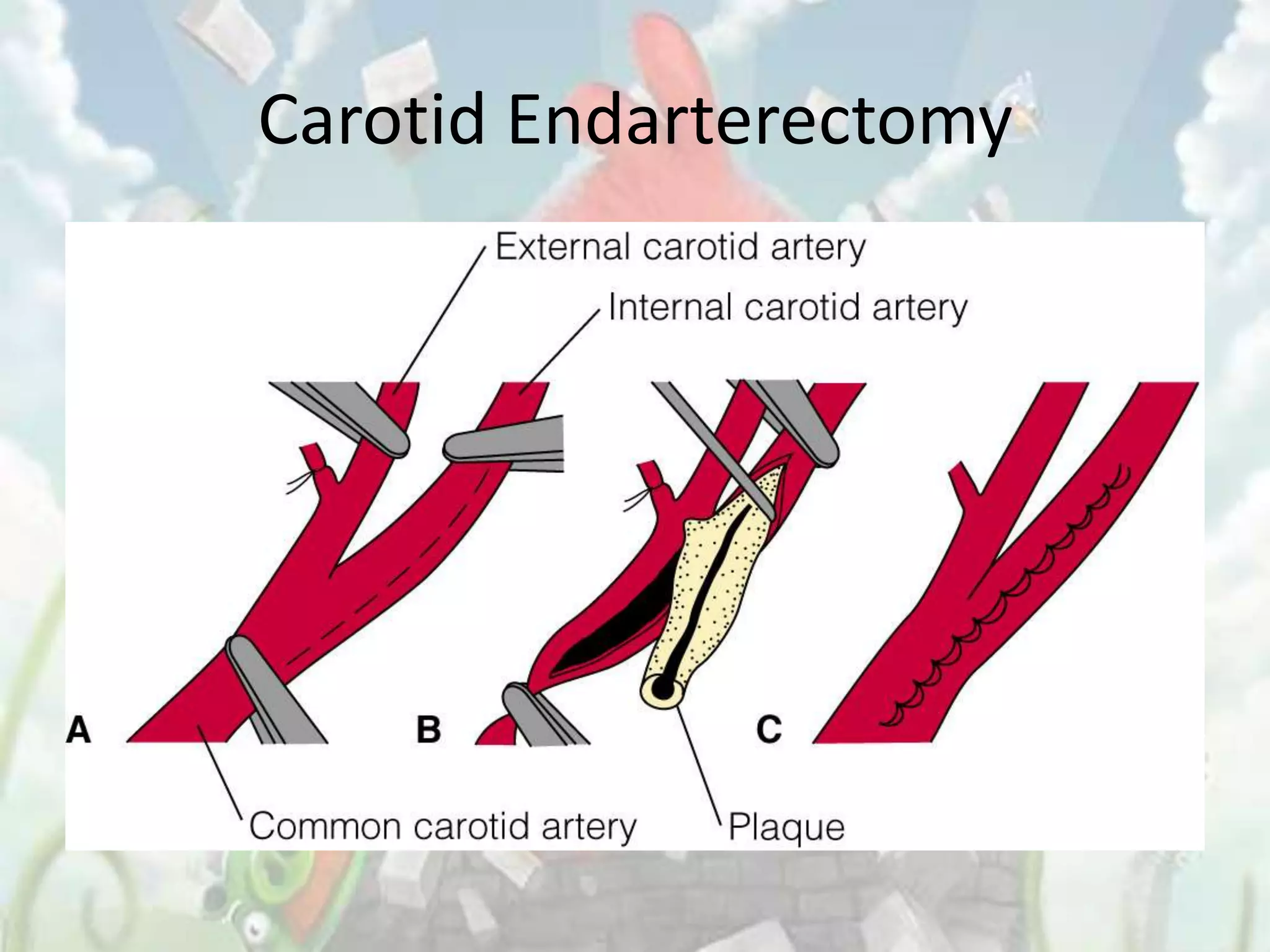 Carotid Endarterectomy
 