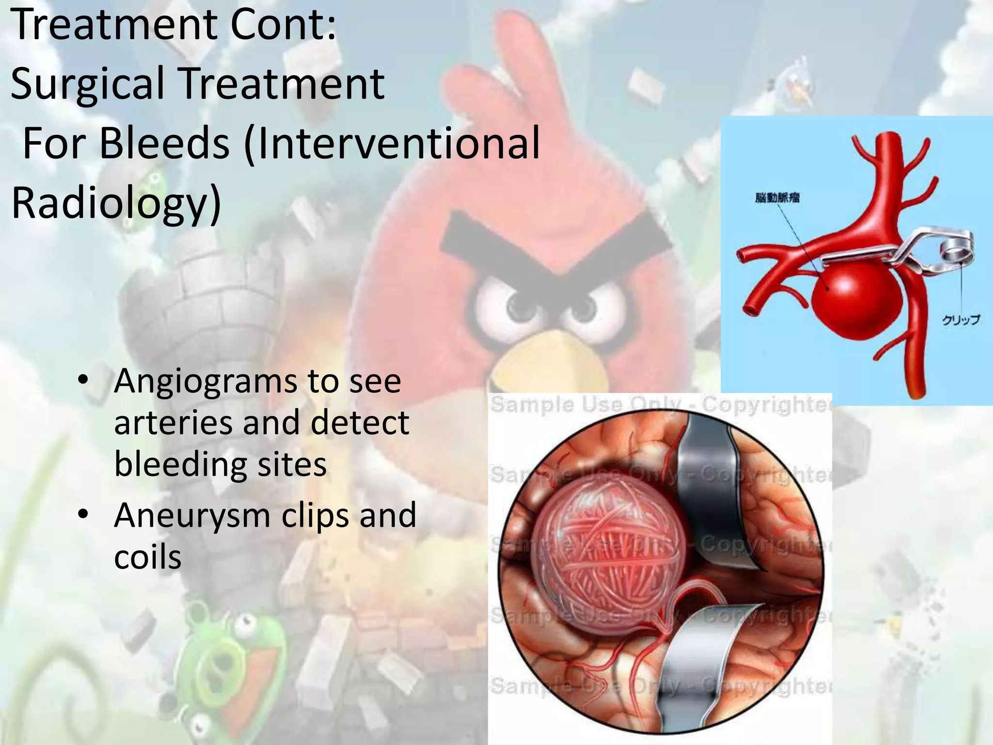 Treatment Cont:
Surgical Treatment
 For Bleeds (Interventional
Radiology)


   • Angiograms to see
     arteries and detect
     bleeding sites
   • Aneurysm clips and
     coils
 