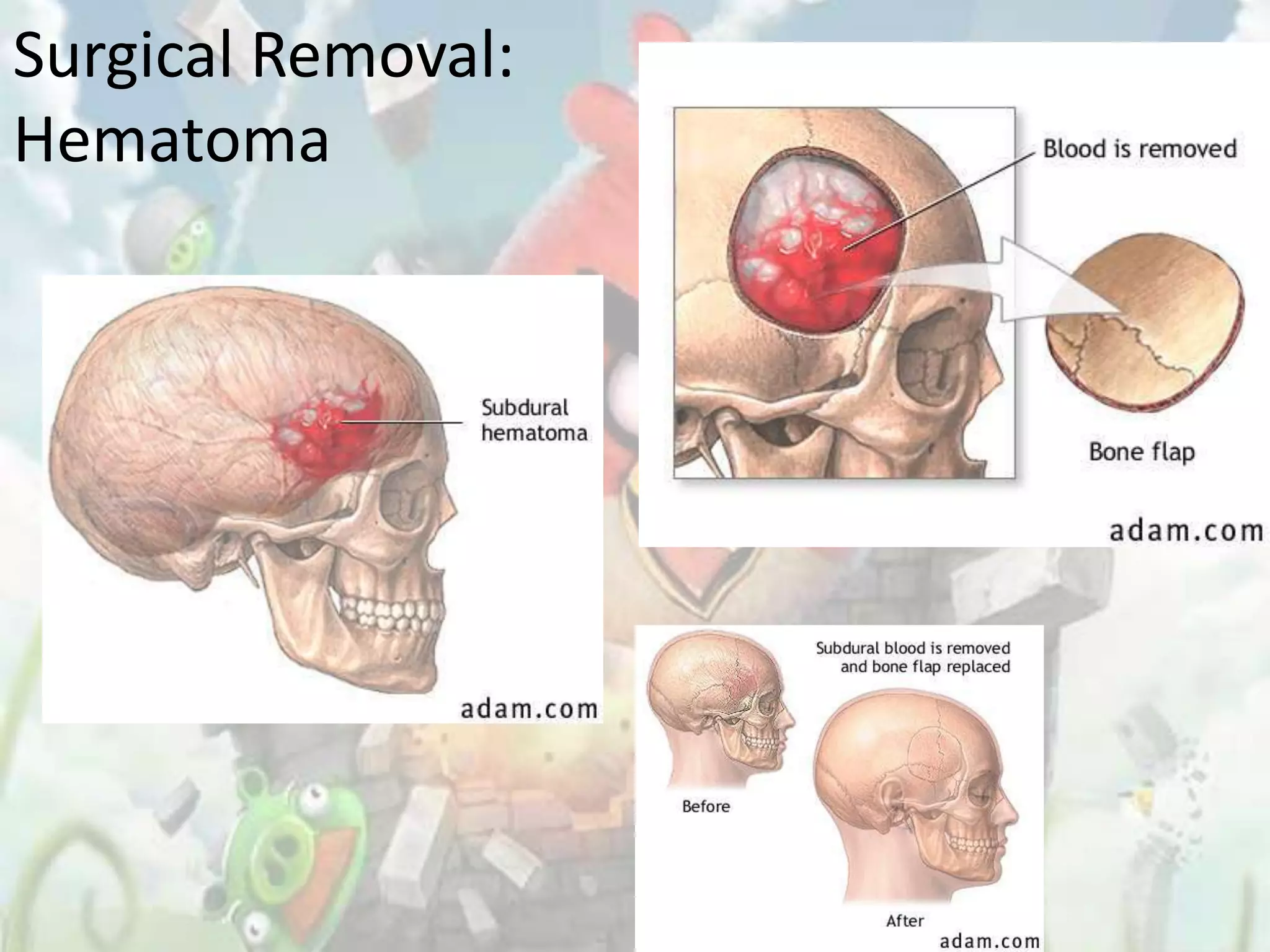 Surgical Removal:
Hematoma
 