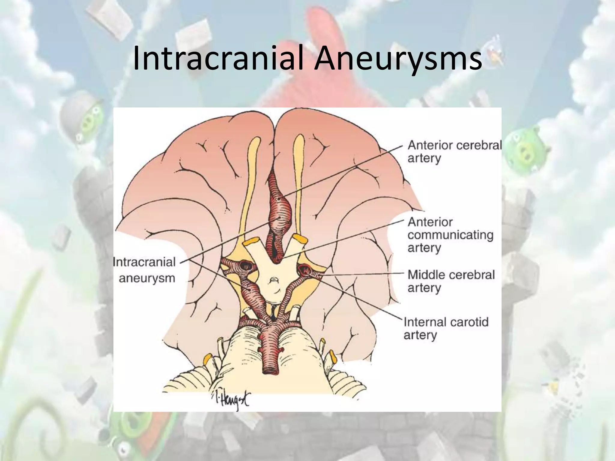 Intracranial Aneurysms
 