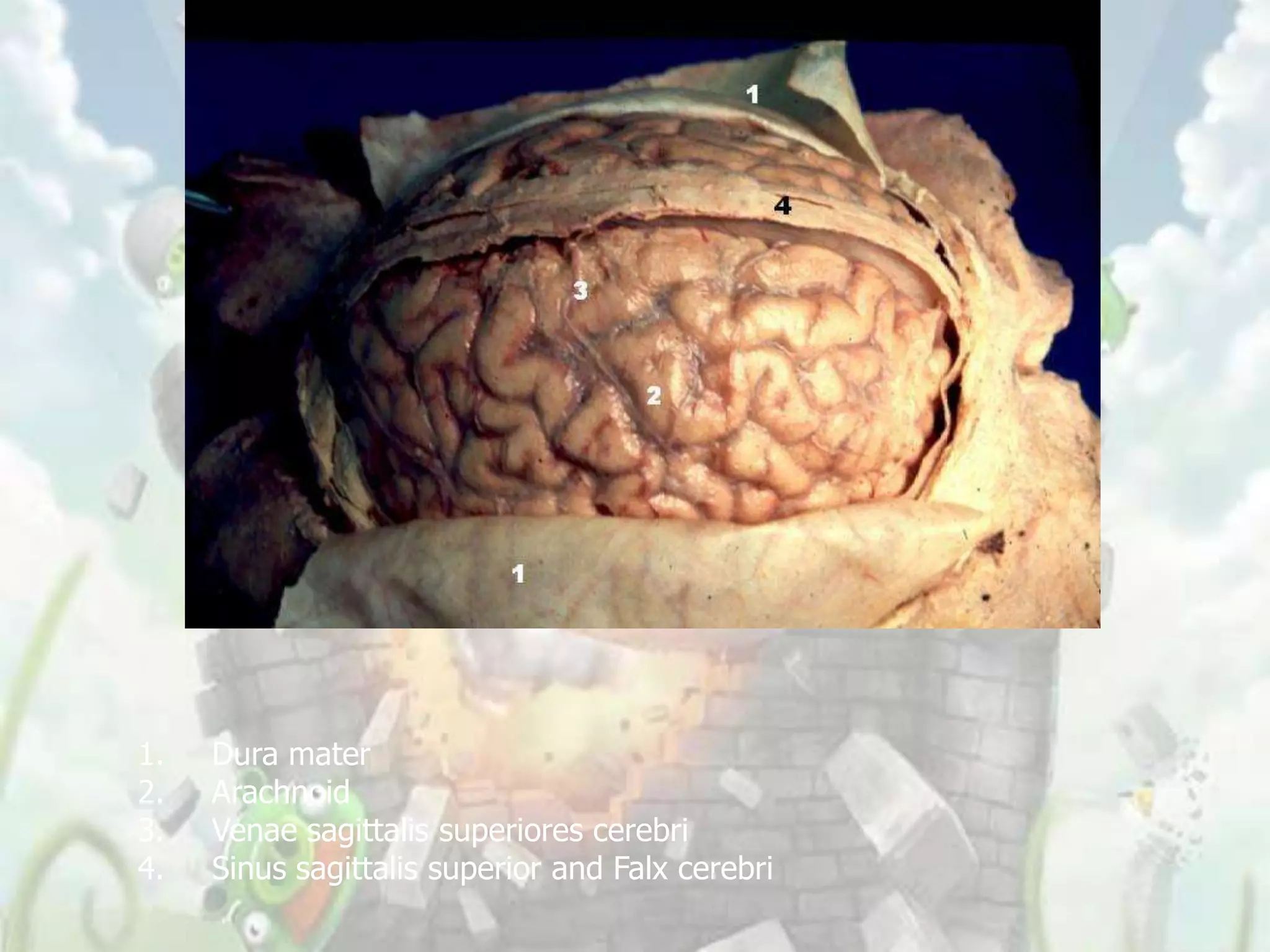 1.   Dura mater
2.   Arachnoid
3.   Venae sagittalis superiores cerebri
4.   Sinus sagittalis superior and Falx cerebri
 