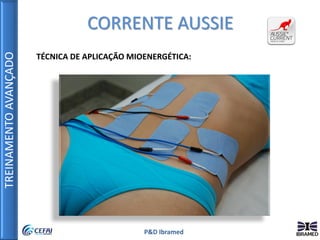 TREINAMENTOAVANÇADO
P&D Ibramed
CORRENTE AUSSIE
TÉCNICA DE APLICAÇÃO MIOENERGÉTICA:
 