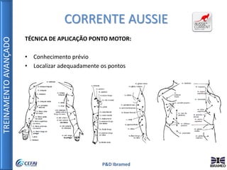 TREINAMENTOAVANÇADO
P&D Ibramed
CORRENTE AUSSIE
TÉCNICA DE APLICAÇÃO PONTO MOTOR:
• Conhecimento prévio
• Localizar adequadamente os pontos
 