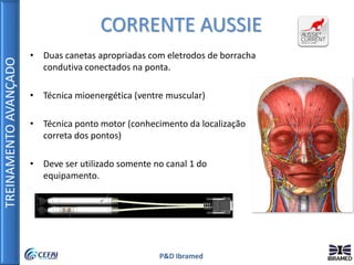 TREINAMENTOAVANÇADO
P&D Ibramed
• Duas canetas apropriadas com eletrodos de borracha
condutiva conectados na ponta.
• Técnica mioenergética (ventre muscular)
• Técnica ponto motor (conhecimento da localização
correta dos pontos)
• Deve ser utilizado somente no canal 1 do
equipamento.
CORRENTE AUSSIE
 