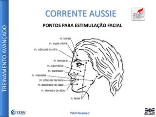 TREINAMENTOAVANÇADO
P&D Ibramed
CORRENTE AUSSIE
PONTOS PARA ESTIMULAÇÃO FACIAL
 