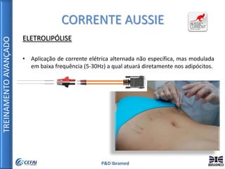 TREINAMENTOAVANÇADO
P&D Ibramed
CORRENTE AUSSIE
ELETROLIPÓLISE
• Aplicação de corrente elétrica alternada não específica, mas modulada
em baixa frequência (5-30Hz) a qual atuará diretamente nos adipócitos.
 