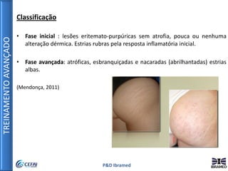 TREINAMENTOAVANÇADO
P&D Ibramed
Classificação
• Fase inicial : lesões eritemato-purpúricas sem atrofia, pouca ou nenhuma
alteração dérmica. Estrias rubras pela resposta inflamatória inicial.
• Fase avançada: atróficas, esbranquiçadas e nacaradas (abrilhantadas) estrias
albas.
(Mendonça, 2011)
 