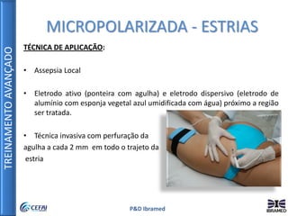 TREINAMENTOAVANÇADO
P&D Ibramed
TÉCNICA DE APLICAÇÃO:
• Assepsia Local
• Eletrodo ativo (ponteira com agulha) e eletrodo dispersivo (eletrodo de
alumínio com esponja vegetal azul umidificada com água) próximo a região
ser tratada.
• Técnica invasiva com perfuração da
agulha a cada 2 mm em todo o trajeto da
estria
MICROPOLARIZADA - ESTRIAS
 