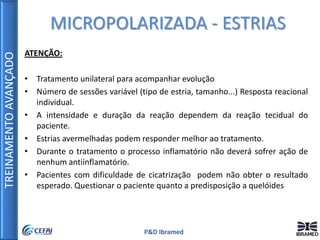 TREINAMENTOAVANÇADO
P&D Ibramed
ATENÇÃO:
• Tratamento unilateral para acompanhar evolução
• Número de sessões variável (tipo de estria, tamanho...) Resposta reacional
individual.
• A intensidade e duração da reação dependem da reação tecidual do
paciente.
• Estrias avermelhadas podem responder melhor ao tratamento.
• Durante o tratamento o processo inflamatório não deverá sofrer ação de
nenhum antiinflamatório.
• Pacientes com dificuldade de cicatrização podem não obter o resultado
esperado. Questionar o paciente quanto a predisposição a quelóides
MICROPOLARIZADA - ESTRIAS
 