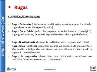 TREINAMENTOAVANÇADO
P&D Ibramed
 Rugas
CLASSIFICAÇÃO DAS RUGAS:
• Rugas Profundas (não sofrem modificações quando a pele é esticada,
rugas decorrentes da exposição solar)
• Rugas Superficiais (pele não exposta, envelhecimento cronológico):
rugas gravitacionais, finas e de expressão (chamadas rugas dinâmicas)
• Rugas Gravitacionais: decorrente da flacidez do envelhecimento facial
• Rugas finas (estáticas): aparecem mesmo na ausência de movimento e
são devido a fadiga das estruturas que constituem a pele devido a
repetição de movimentos
• Rugas de expressão: decorrente dos movimentos repetidos dos
músculos faciais e aparece com o movimento.
 