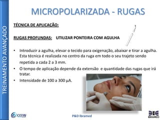 TREINAMENTOAVANÇADO
P&D Ibramed
TÉCNICA DE APLICAÇÃO:
RUGAS PROFUNDAS: UTILIZAR PONTEIRA COM AGULHA
• Introduzir a agulha, elevar o tecido para oxigenação, abaixar e tirar a agulha.
Esta técnica é realizada no centro da ruga em todo o seu trajeto sendo
repetida a cada 2 a 3 mm.
• O tempo de aplicação depende da extensão e quantidade das rugas que irá
tratar.
• Intensidade de 100 a 300 µA.
MICROPOLARIZADA - RUGAS
 