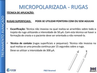 TREINAMENTOAVANÇADO
P&D Ibramed
TÉCNICA DE APLICAÇÃO:
RUGAS SUPERFICIAIS: PODE-SE UTILIZAR PONTEIRA COM OU SEM AGULHA
• Escarificação: Técnica não invasiva na qual realiza-se arranhões sobre todo o
trajeto da ruga utilizando a intensidade de 50 µA. Com esta técnica vai haver a
formação de crosta e o paciente deve ser orientado a não removê-la.
• Técnica de contato (rugas superficiais e pequenas): Técnica não invasiva na
qual realiza-se uma pressão contínua por 15 segundos sobre a ruga.
Deve-se utilizar a intensidade de 300 µA.
MICROPOLARIZADA - RUGAS
 