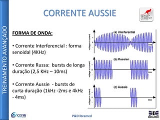 TREINAMENTOAVANÇADO
P&D Ibramed
FORMA DE ONDA:
• Corrente Interferencial : forma
senoidal (4KHz)
• Corrente Russa: bursts de longa
duração (2,5 KHz – 10ms)
• Corrente Aussie - bursts de
curta duração (1kHz -2ms e 4kHz
- 4ms)
CORRENTE AUSSIE
 