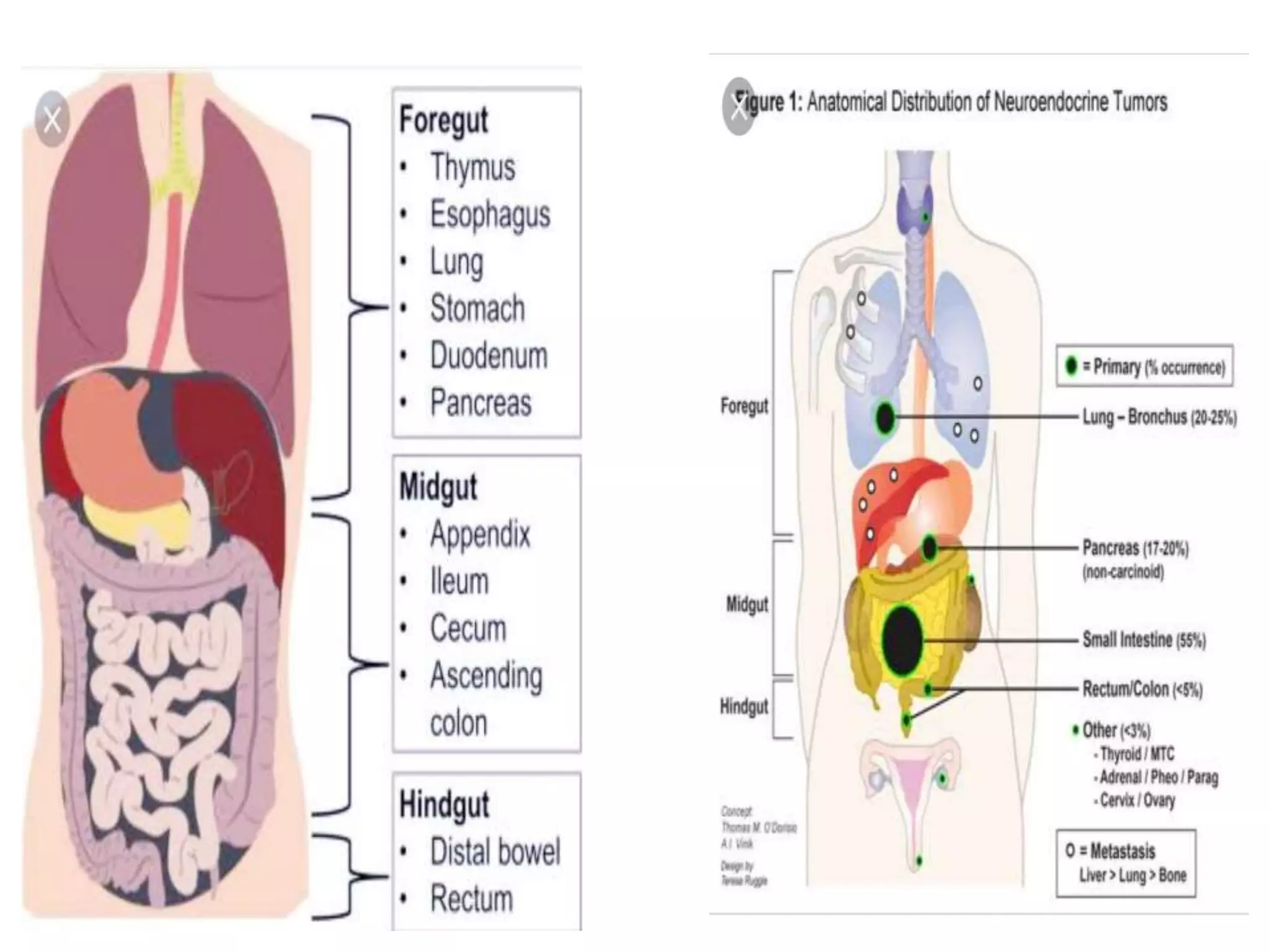 Net Cancer gastrointestinal Neuro endocrine tumors , GIT NET | PPTX